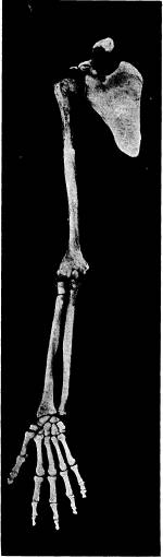 <bFig. 83. Armens skelett hos människan (efter<bKlaatsch).<b