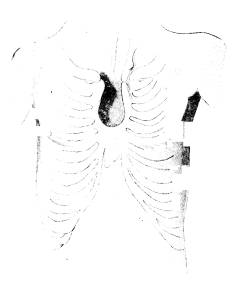 Fig. 119. Människa med bröstbensspringa <b(efter O. Schultze).