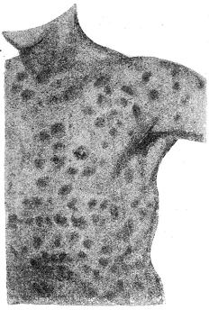 Fig. 23. Syfilitiska fläckutslag (Roseola).