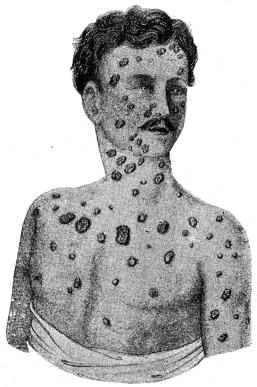 Fig. 24. Syfilitiska fjäll- och knotter-utslag