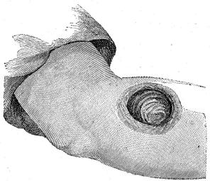 Fig. 25. Sekundärt syfilitiskt sår (rupia).