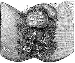 Fig. 27. Syfilitiska breda papler (platta veneriska vårtor).