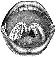 Fig. 28. Platta veneriska vårtor å mjuka<bgomen, tungan och mungiporna.