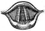 Fig. 29. Syfilitisk sårbildning å<bljudband och brosk i<bstruphufvudet, såsom bilden ter sig i<bstrupspegeln.