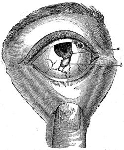 Fig. 30. Syfilitisk inflammation och nybildning i ögat.
