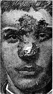 Fig. 32. Syfilitiska sår i tredje skedet.