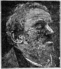 Fig. 33 och 34. Syfilitiska och såriga svulster i ansiktet i tredje skedet.