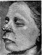 Fig. 35. Syfilitiska sår i tredjo skedet.