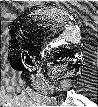 Fig. 36. Syfilitisk benröta i näsan<bi tredje skedet.