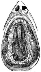 Fig. 41. Benröta i gomhvalfvet<bvid syfilis i tredje skedet.