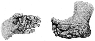 Fig. 43 och 44. Kännetecknande blåsutslag (pemfigus)i hålhanden och under<bfotbladet på barn vid medfödd syfilis.