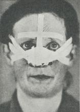 Fig. 4. Radiumpræparat appliceret paa Næsen (med Hæfteplasterbandage). — Fig. 5. Radiumpræparat<bappliceret paa Underlæben (med Hæfteplasterbandage). — Fig. 6. Radiumpræparat appliceret i Øjenkrogen<bmed Afdækning af selve Øjet (Hæfteplasterbandage fikseret paa Gazebind om Haaret).