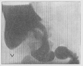 Fig. 4. Ventrikel med Kræftsvulst (Defekten i Skyggen).