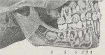 Fig. 5. Tandskiftet hos et 5 Aars Barn (Façaden af<bKæbebenet opmejslet). Højre Mælketandrækker: 1—2<bFortænderne, 3 Hjørnetanden, 4—5 Kindtænderne, 6<bførste Molars Krone færdigdannet (2/3 naturlig Størr.).