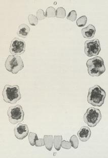 Fig. 6. Karies i Mælketandrækken hos en 8-aarig<bPige (Kommuneskole). De mørke Pletter viser<bUdbredningen af Karies — kun de skiftede Fortænder i<bUndermunden (U) er uskadte; 6 Aars Molarerne<ballerede stærkt angrebne. (Naturlig Størrelse).<bProfessor <span class=