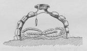 Fig. 7. Snit gennem Reden af en<banden enlig Hveps (Eumenes).<bReden er fritstaaende, belagt med<bKiselsten øg forsynet med<bIndgangshul foroven.