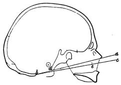 Bild 1. Hufvadskål af svensk (man) (I <su<smal1</smal</su/<su<smal3</smal</su nat. storl.), genomsågad lodrätt i medellinien<b= sagittal genomskärning, för att visa den Davbentontska vinkeln <span class=