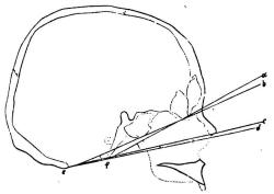 Bild 13. Hufvudskål af ungrare (slav?), i sagittal genomskärning (<su<smal1</smal</su/<su<smal3</smal</su storl.) m. tillh.<bHär äro angifna den Daubentonska vinkeln <span class=